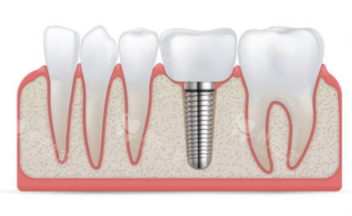 种植牙和临牙示意图 种植牙和临牙示意图