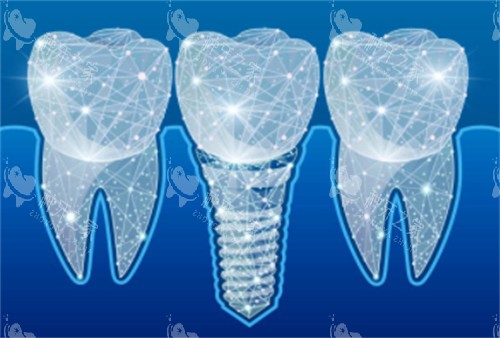 种植牙科技感卡通 种植牙科技感卡通