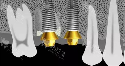 种植牙术后ct 种植牙术后ct
