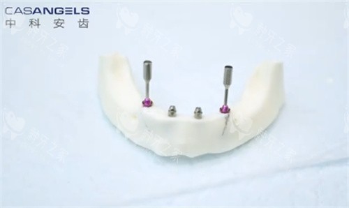 中科安齿种植牙
