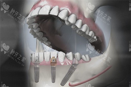 德国SKY种植牙模拟图
