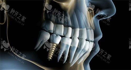 单颗种植牙动画示意图展示 单颗种植牙动画示意图展示