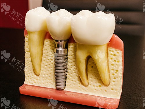 种植牙模型图 种植牙模型图