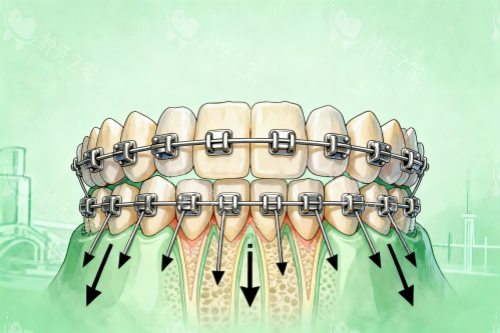 牙齿矫正模型图片展示 牙齿矫正模型图片展示
