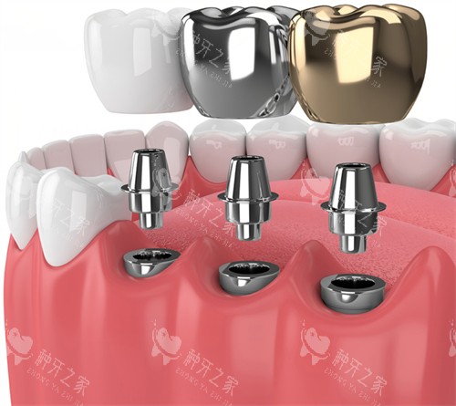 种植牙动画示意图展示 种植牙动画示意图展示