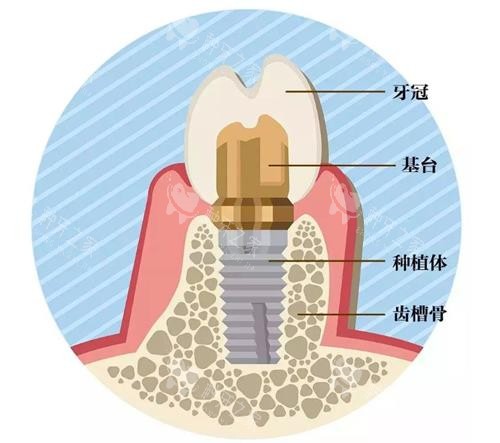 种植牙的组成 种植牙的组成