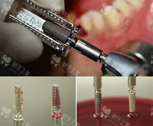 康盛种植牙照片 康盛种植牙照片
