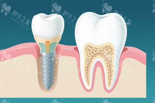 种植牙动画十一 种植牙动画十一