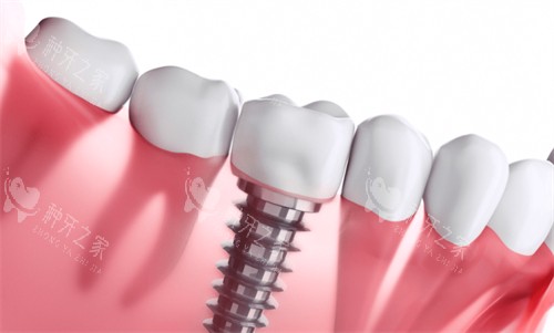 种植牙种植后的样子 种植牙种植后的样子