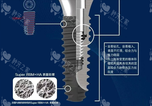 种植牙处理 种植牙处理