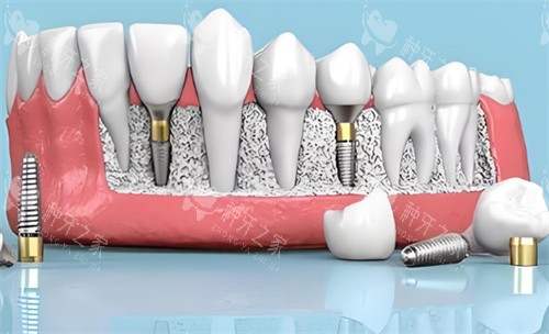 种植牙材料动画展示 种植牙材料动画展示