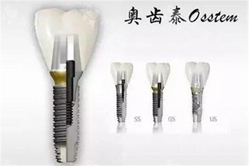 奥齿泰种植牙三个系列 奥齿泰种植牙三个系列