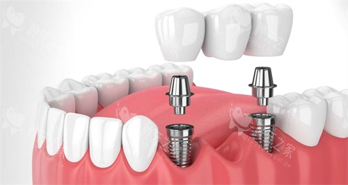 仙桃源博士口腔种植牙怎么样？穿颧种植不用植骨也能种