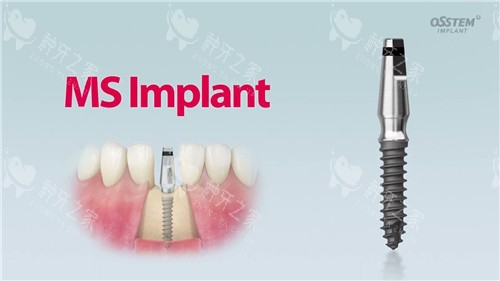 奥齿泰种植牙 奥齿泰种植牙