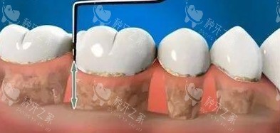 沈阳种植牙收费价格表！附植体价格明细！