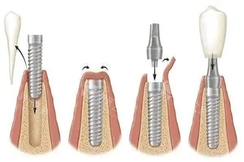 种植牙步骤示意图 种植牙步骤示意图