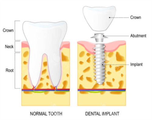百齿泰种植牙闭眼冲！适配多种缺牙情况+术后并发症少
