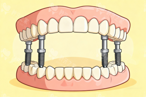 全口种植牙一览 全口种植牙一览