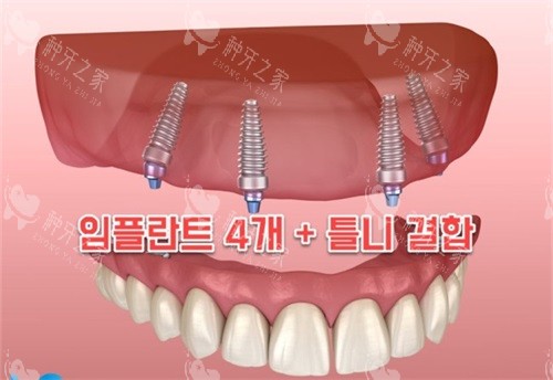 齿恒种植牙质量好吗？中高端品质+集采价加持