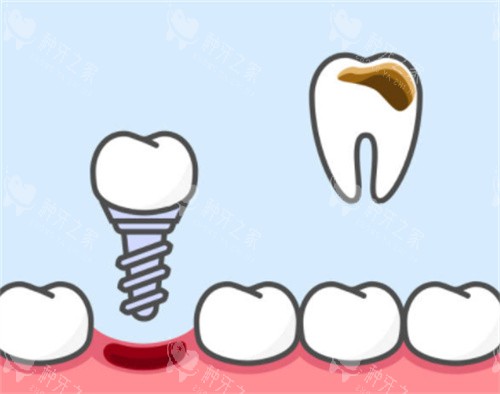 2025永康种植牙多少钱一颗？永康种植牙价格全解析