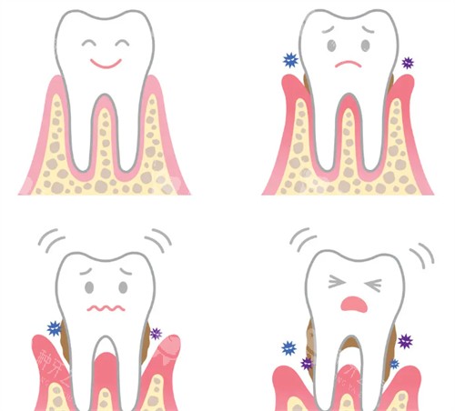 牙齿松动解决办法 牙齿松动解决办法