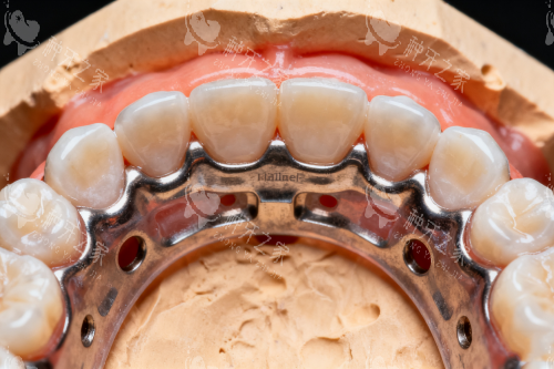 牙齿矫正之后的样子展示 牙齿矫正之后的样子展示