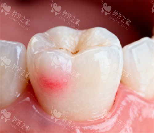 单颗牙齿图片 单颗牙齿图片