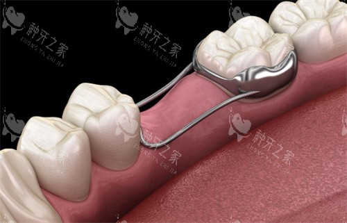 牙齿间隙保持器 牙齿间隙保持器