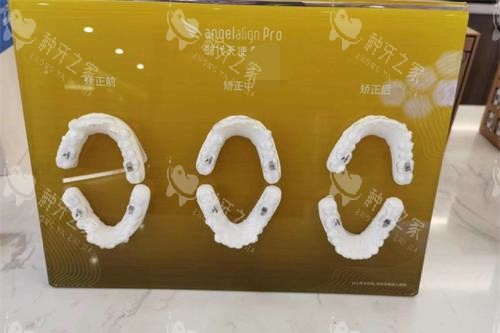 青岛优诺口腔时代天使牙套 青岛优诺口腔时代天使牙套