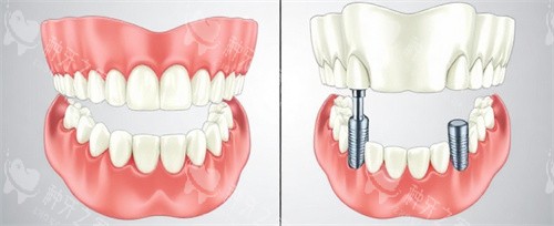 种植牙前后动画