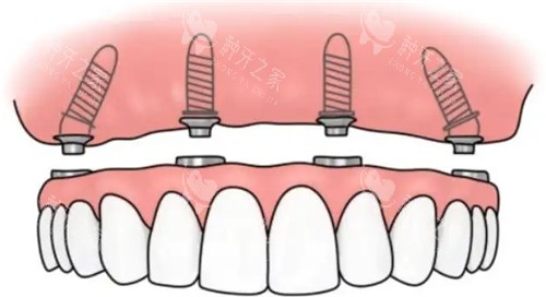 南宁贝尔口腔种植牙价格表:民族大道国贸,看牙便捷