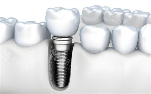 种植牙动画图片展示图