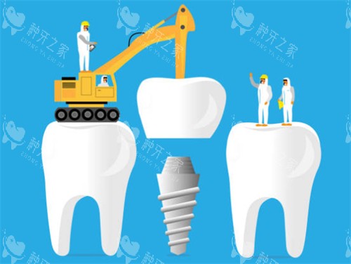 种植牙工程示意图