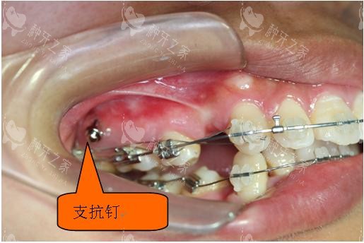牙齿矫正骨钉种植钉口腔示意图