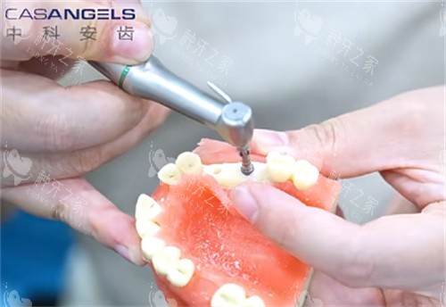 中科安齿种植牙钻孔