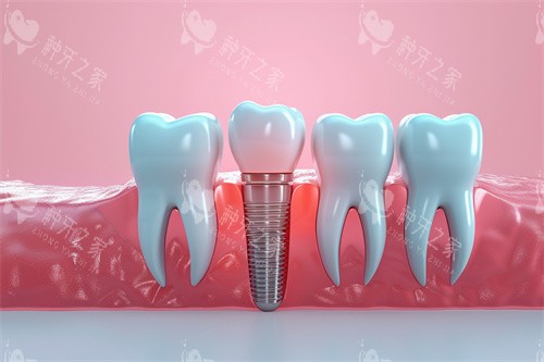 种植牙漫画模型解剖图