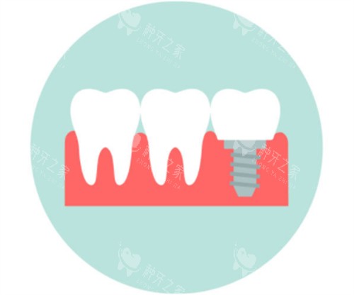种植牙模拟卡通图 种植牙模拟卡通图