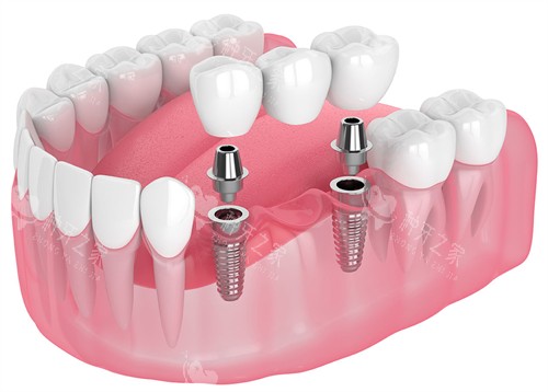 种植牙的构成 种植牙的构成