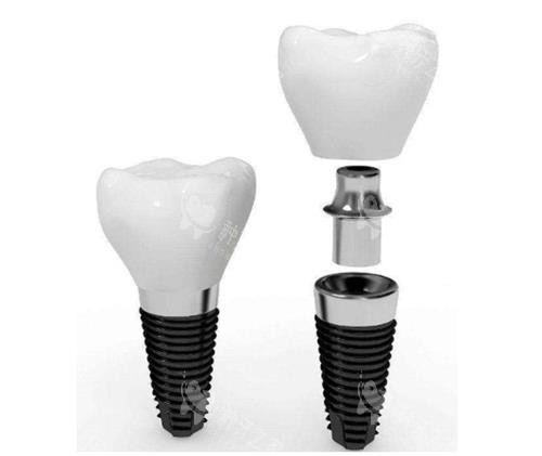 种植牙组成图 种植牙组成图