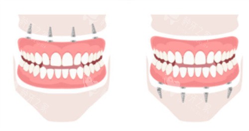 上半口种植牙和下半口种植牙 上半口种植牙和下半口种植牙