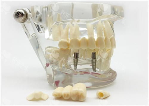 种植牙模具