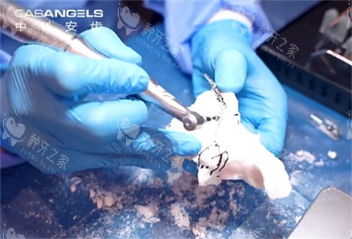 中科安齿种植牙操作过程