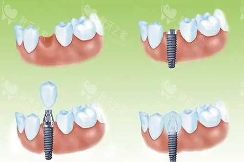 徐州十大口碑牙科：矫正/种植/贴面优选名单