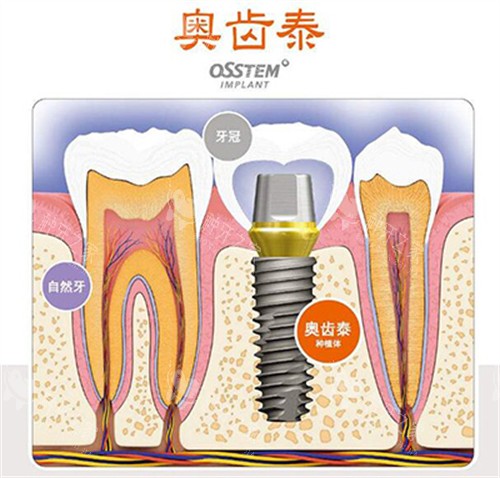 奥齿泰种植体材料展示