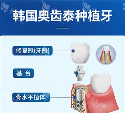 奥齿泰种植体材料图