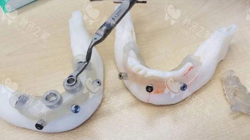 种植牙导板3D打印.webp