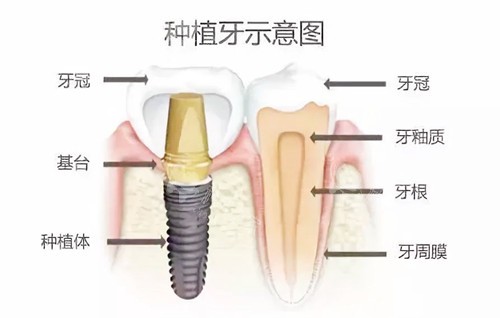 种植牙示意图