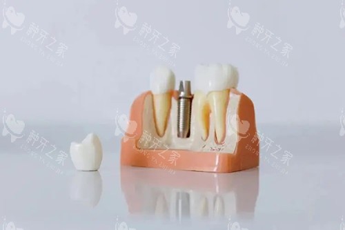 单颗种植牙模型摆件 单颗种植牙模型摆件