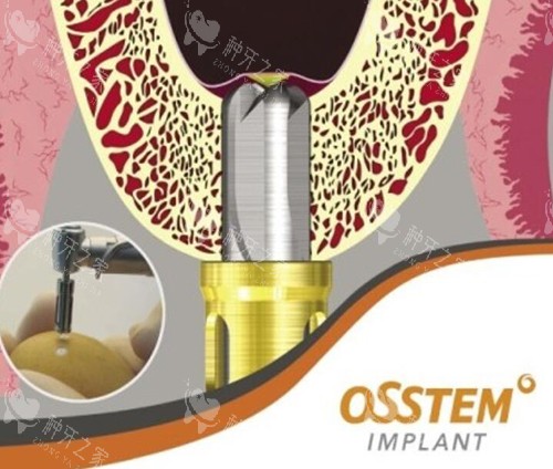 意大利历德种植牙怎么样？质量稳定耐用超靠谱！