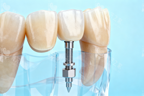 意大利西泰克种植牙好用吗？种植牙选它超省心！